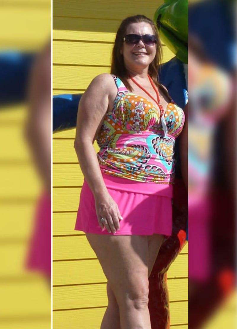 Patients 40-59 Years Old Before & After Gallery - Patient 14494499 - Image 1