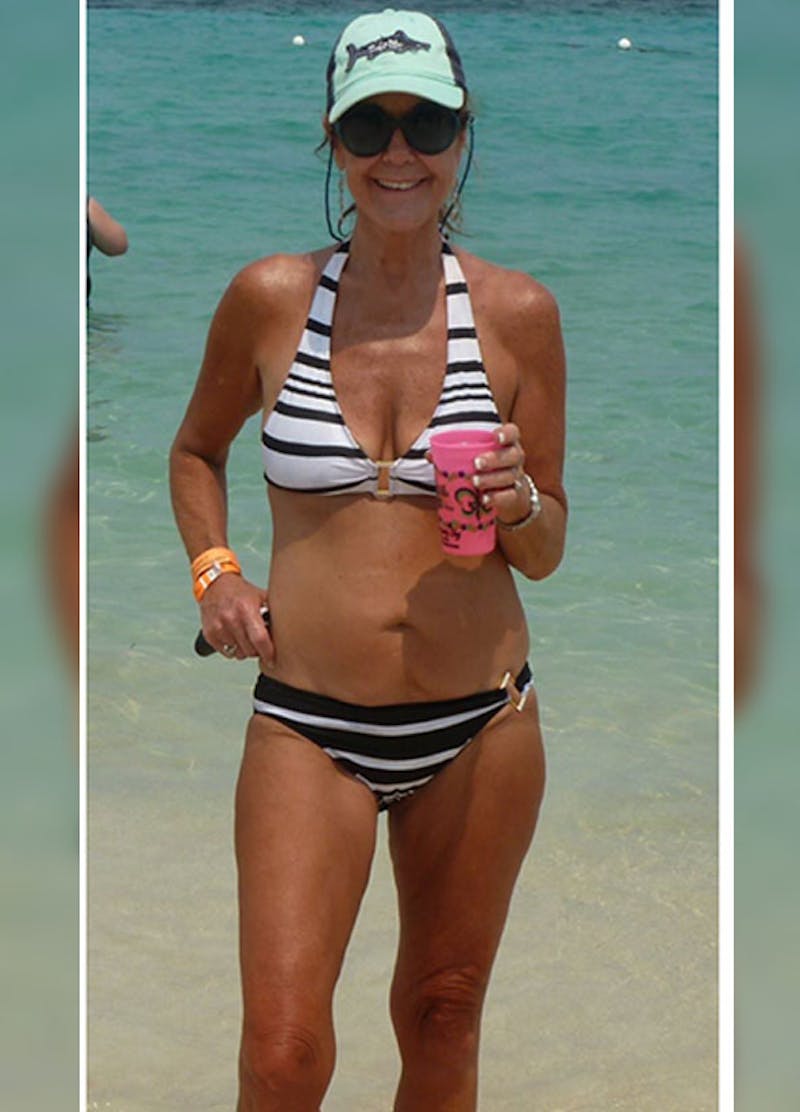 Patients 40-59 Years Old Before & After Gallery - Patient 14494499 - Image 2