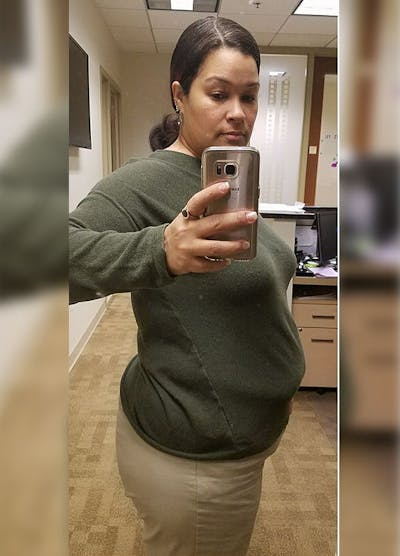 Patients 40-59 Years Old Before & After Gallery - Patient 14494500 - Image 1