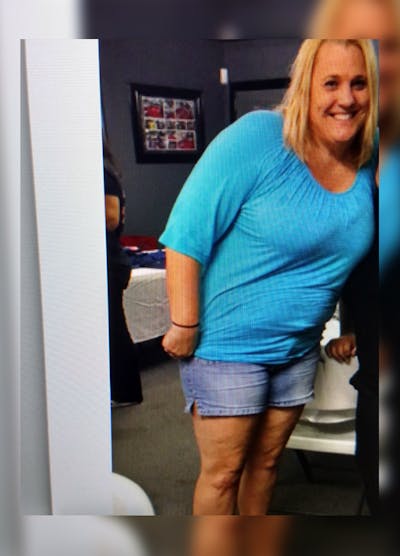 Patients 40-59 Years Old Before & After Gallery - Patient 14494504 - Image 1