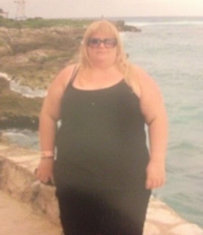 Patients 40-59 Years Old Before & After Gallery - Patient 14494511 - Image 1