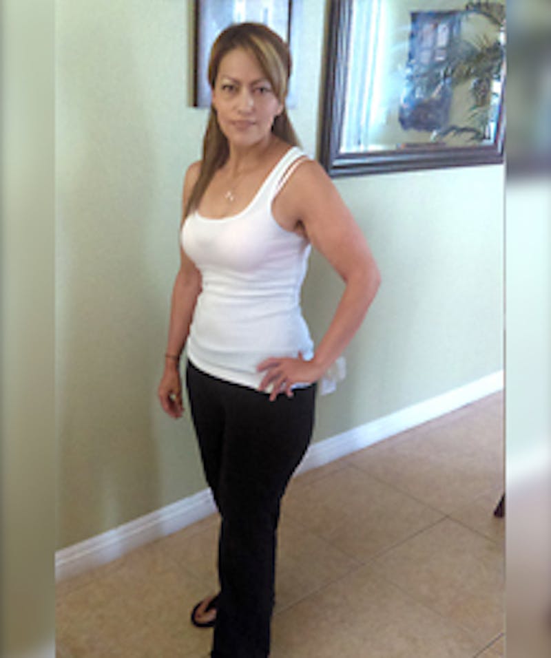 Patients 40-59 Years Old Before & After Gallery - Patient 14494518 - Image 2