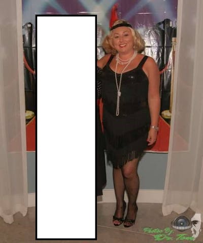 Patients 40-59 Years Old Before & After Gallery - Patient 14494521 - Image 1