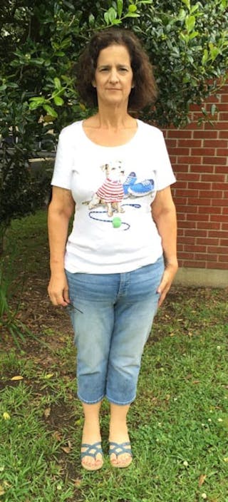 Patients 40-59 Years Old Before & After Gallery - Patient 14494522 - Image 2