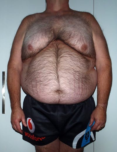 Patients 40-59 Years Old Before & After Gallery - Patient 14494527 - Image 1