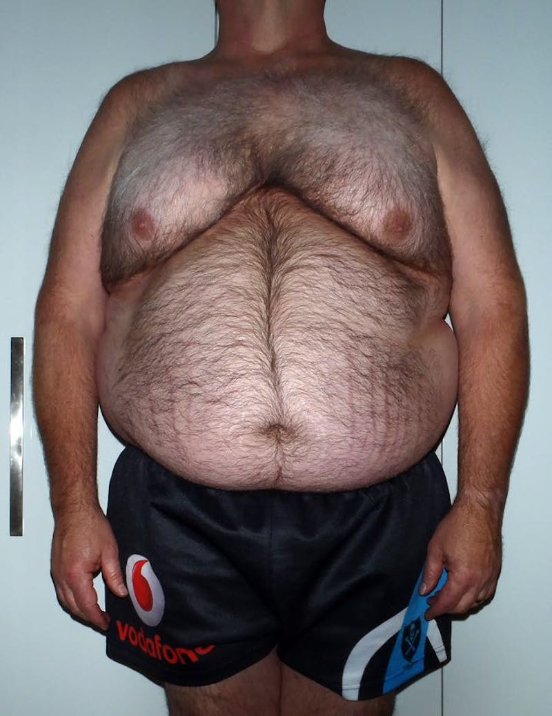 Patients 40-59 Years Old Before & After Gallery - Patient 14494527 - Image 1