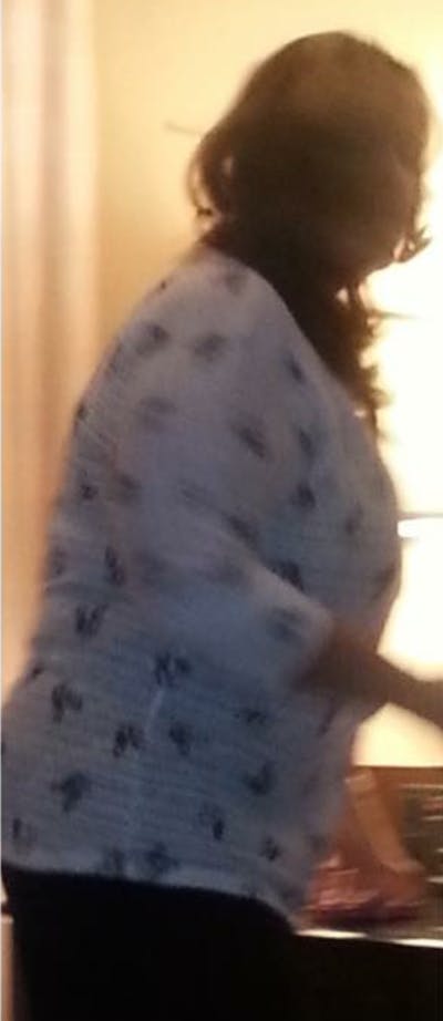 Patients 40-59 Years Old Before & After Gallery - Patient 14494540 - Image 1