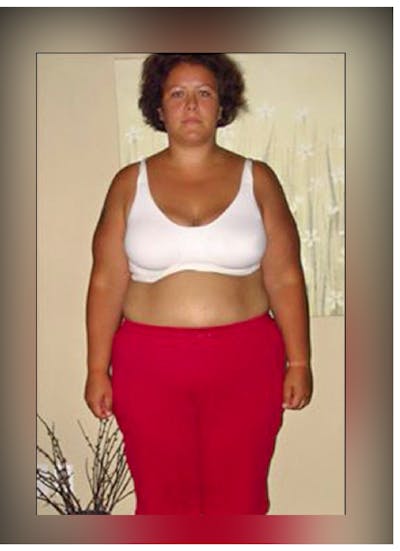 Patients 40-59 Years Old Before & After Gallery - Patient 14494552 - Image 1