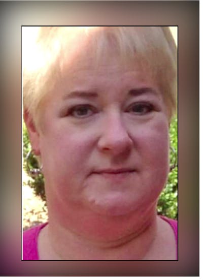 Patients 40-59 Years Old Before & After Gallery - Patient 14494553 - Image 1