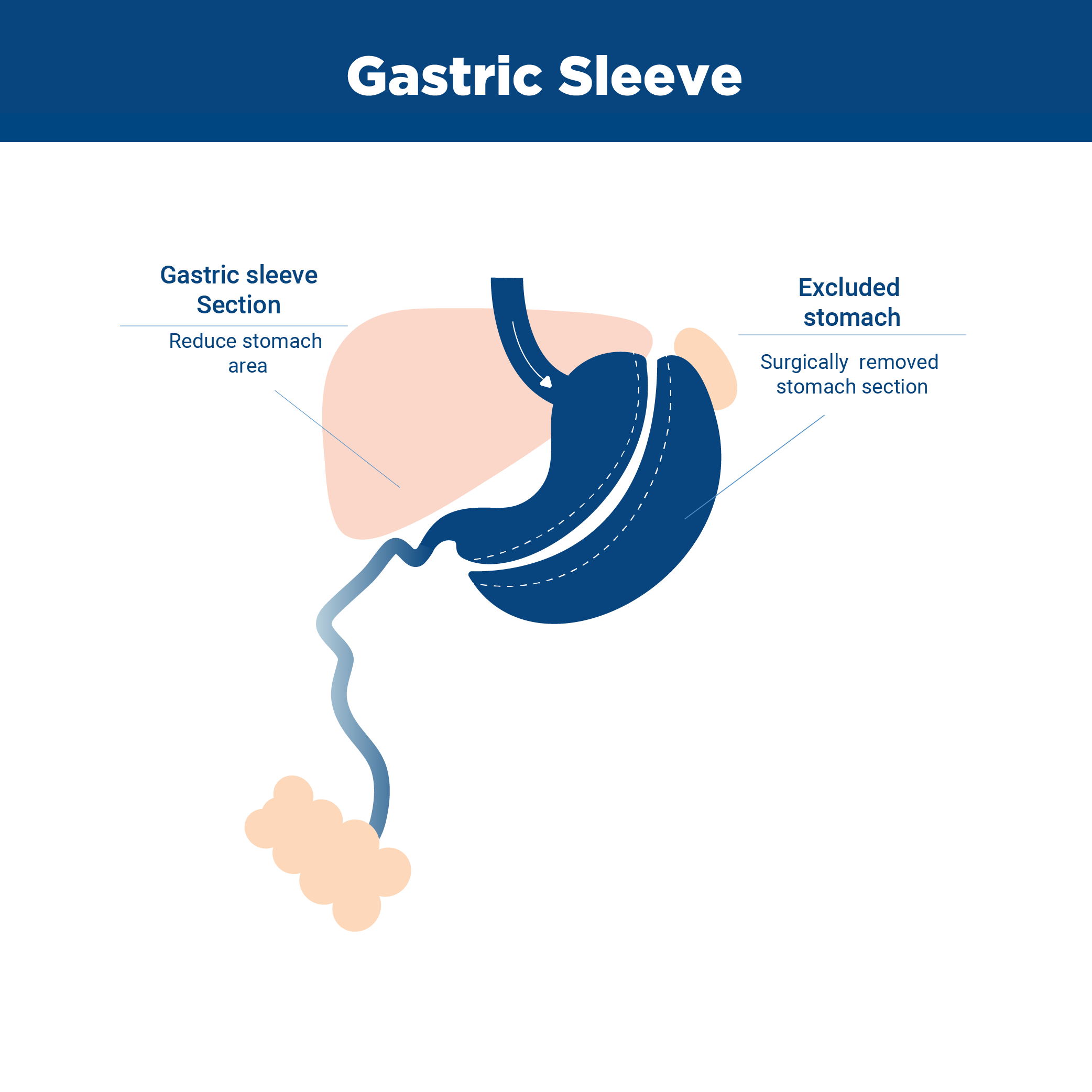 Gastric Sleeve Infographic