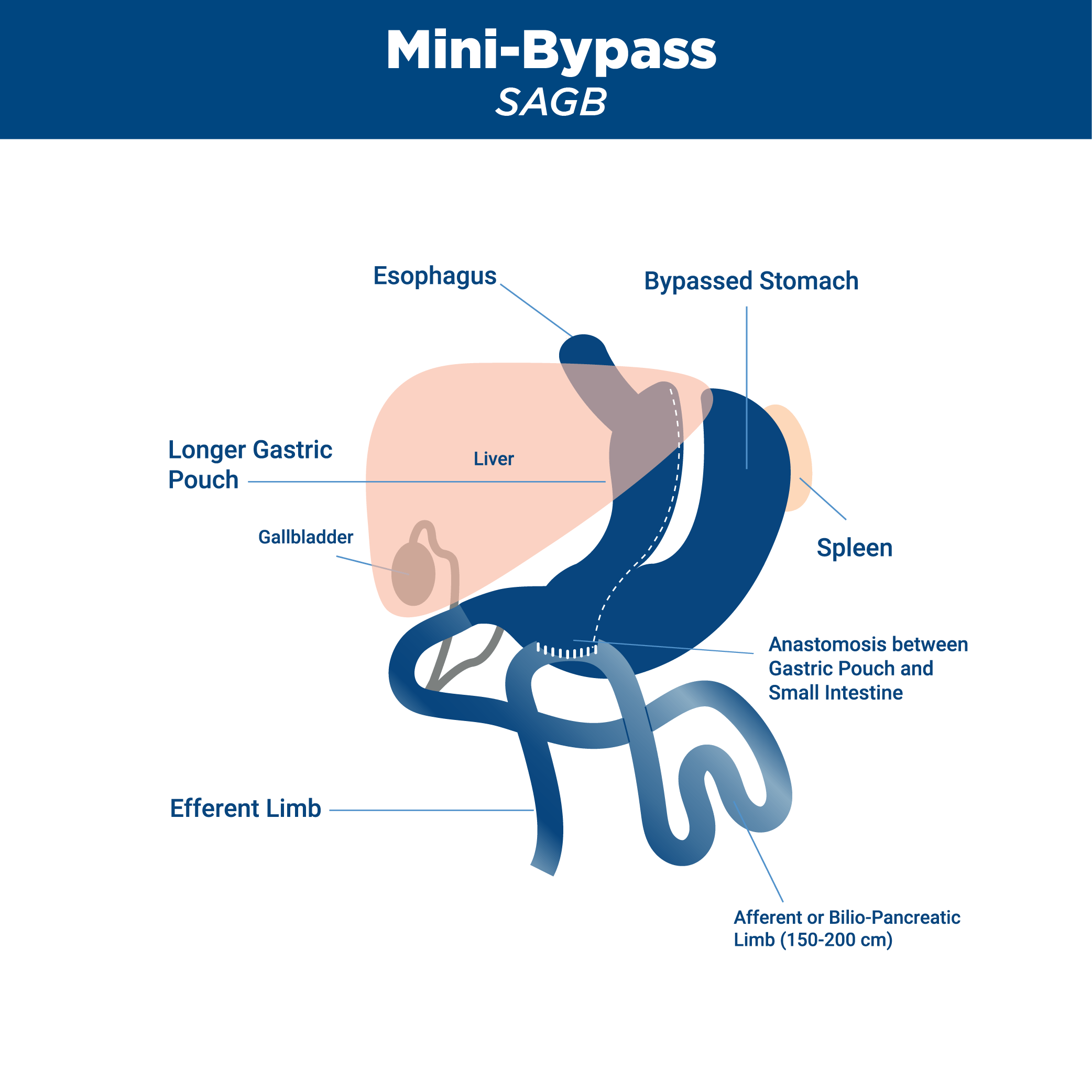 Diagram of mini gastric bypass from Obesity Control Center in Tijuana, Mexico