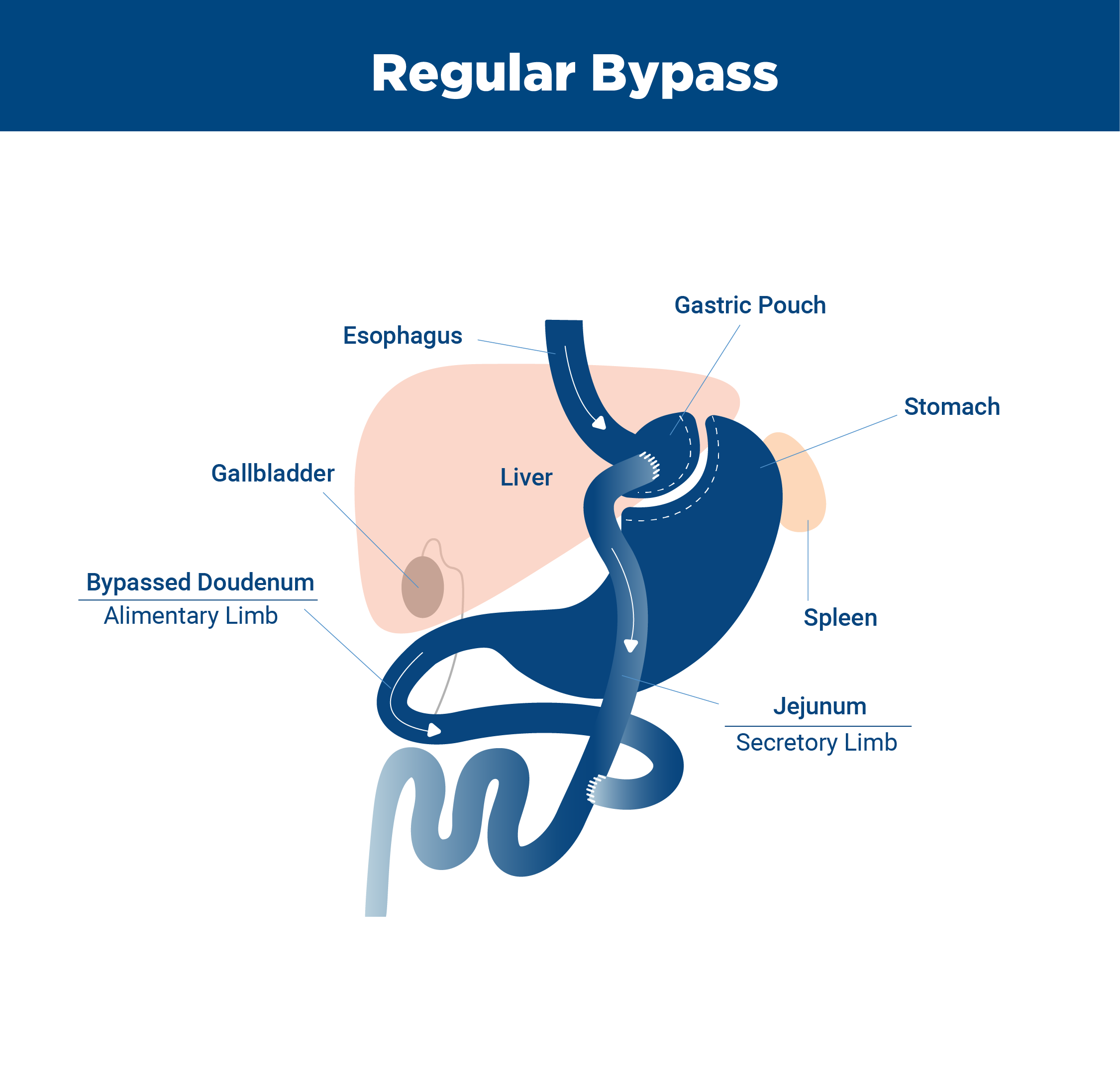 Waarom Geen NSAID Na Gastric Bypass Wat Je Moet Weten