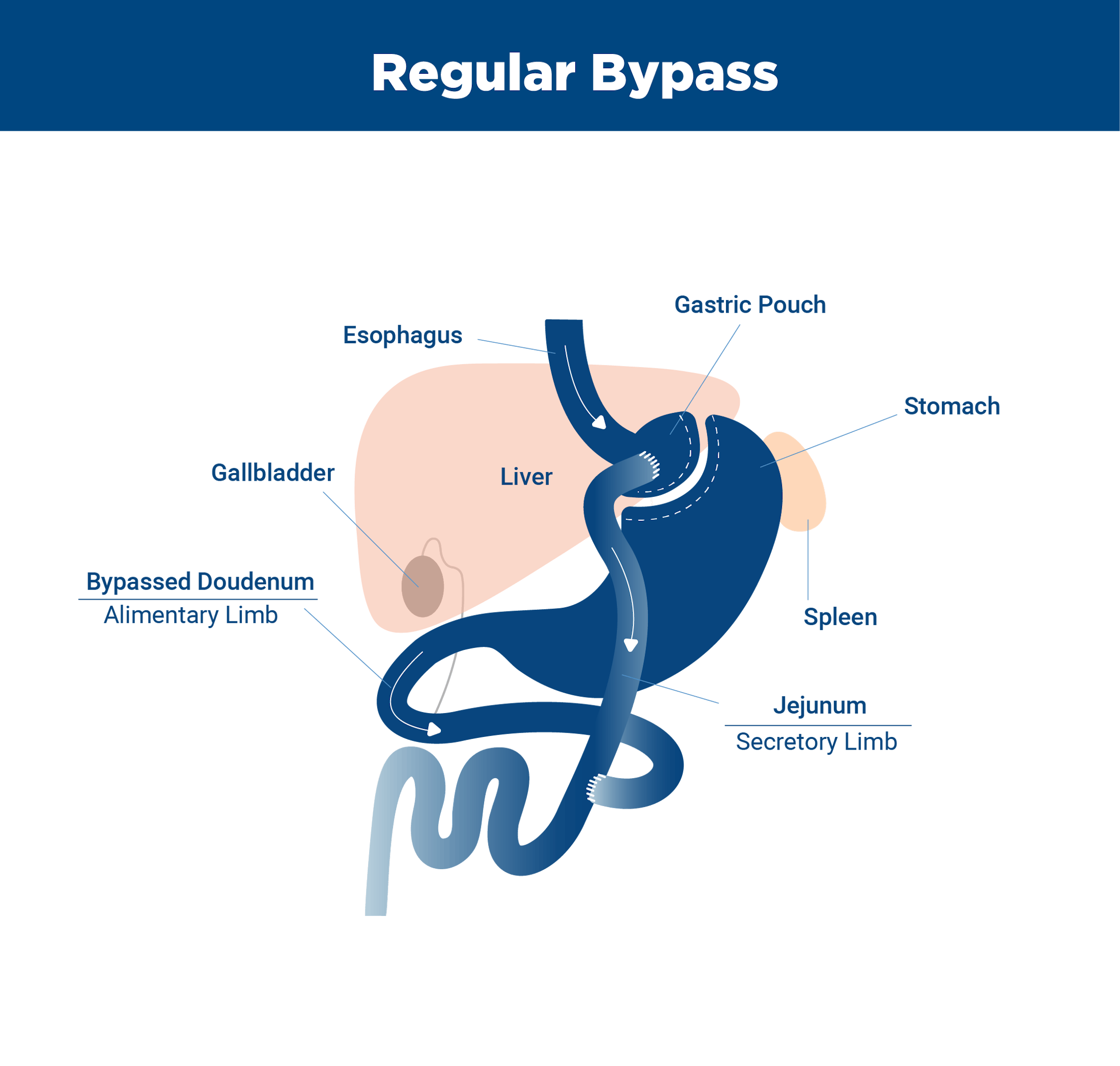 Diagram of bypass surgery