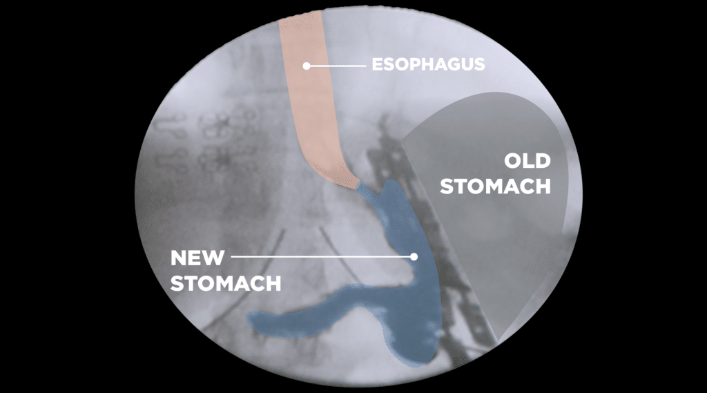 BariClip Surgery Tijuana, Mexico FastResults WeightLoss Surgery