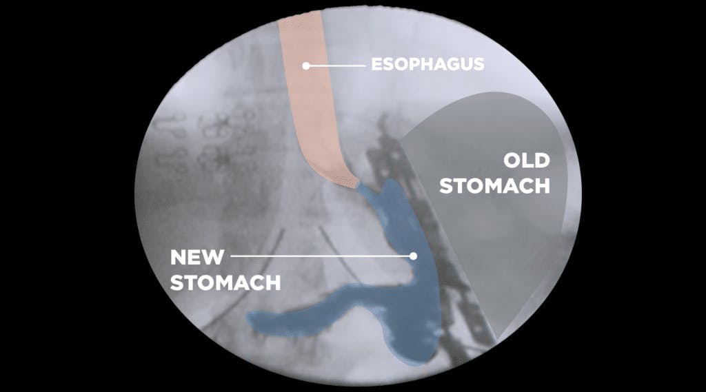 Xray image of new and old stomach comparison after bariclip surgery