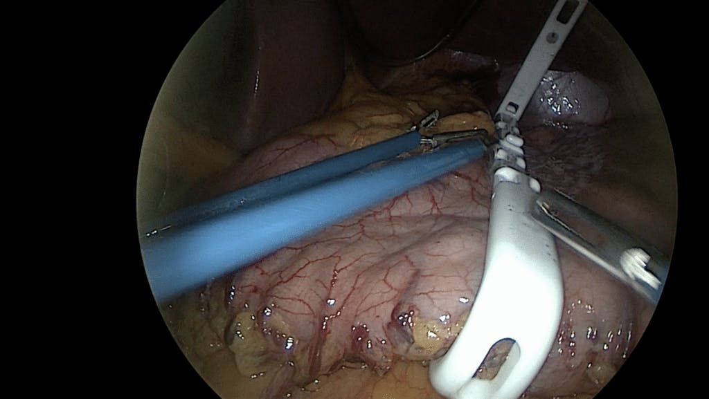 Photo during bariclip surgery