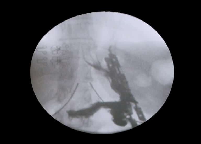 Xray image of bariclip surgery