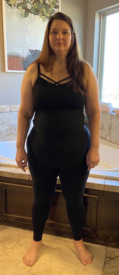 Patients 40-59 Years Old Before & After Gallery - Patient 55366402 - Image 1