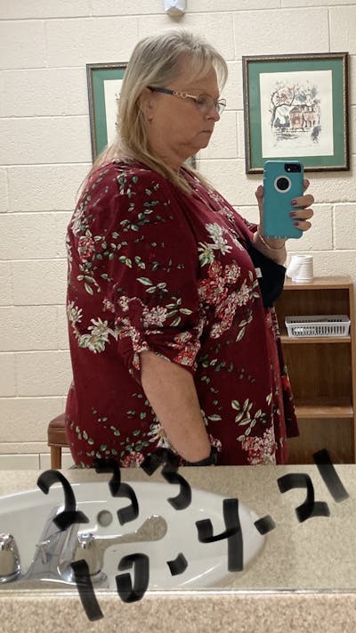 Patients 40-59 Years Old Before & After Gallery - Patient 55649669 - Image 1