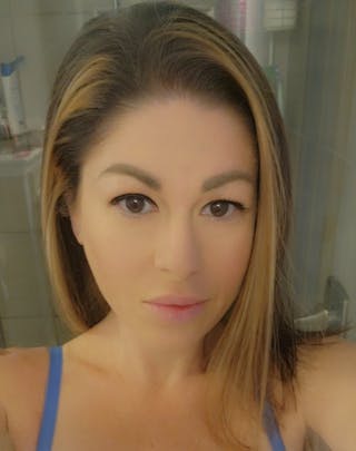 Patients 20-39 Years Old Before & After Gallery - Patient 55649673 - Image 2