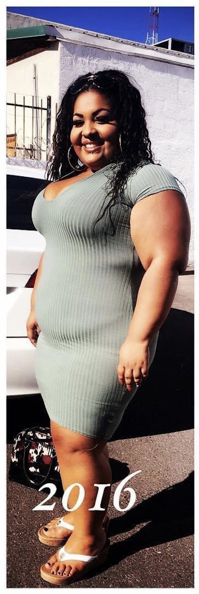 Patients 20-39 Years Old Before & After Gallery - Patient 55649676 - Image 1