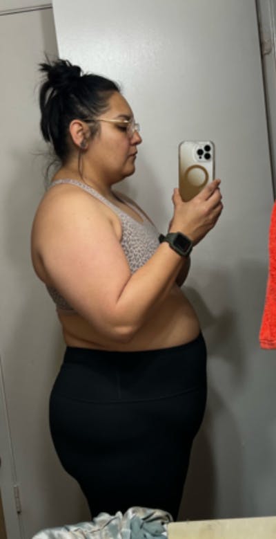 Patients 20-39 Years Old Before & After Gallery - Patient 55729295 - Image 1