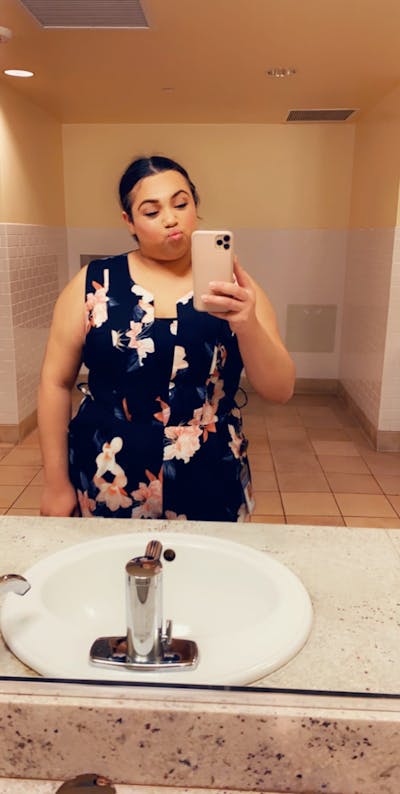 Patients 20-39 Years Old Before & After Gallery - Patient 55962165 - Image 1