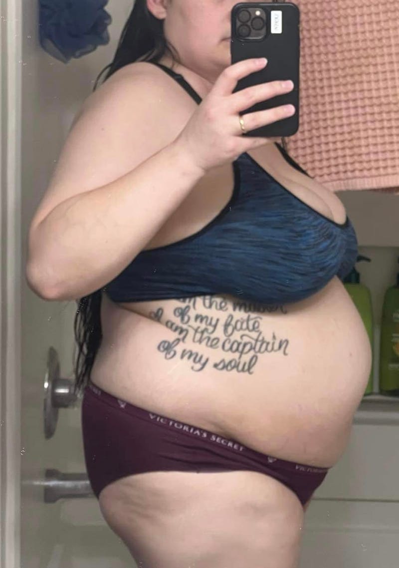 Patients 20-39 Years Old Before & After Gallery - Patient 55962166 - Image 1