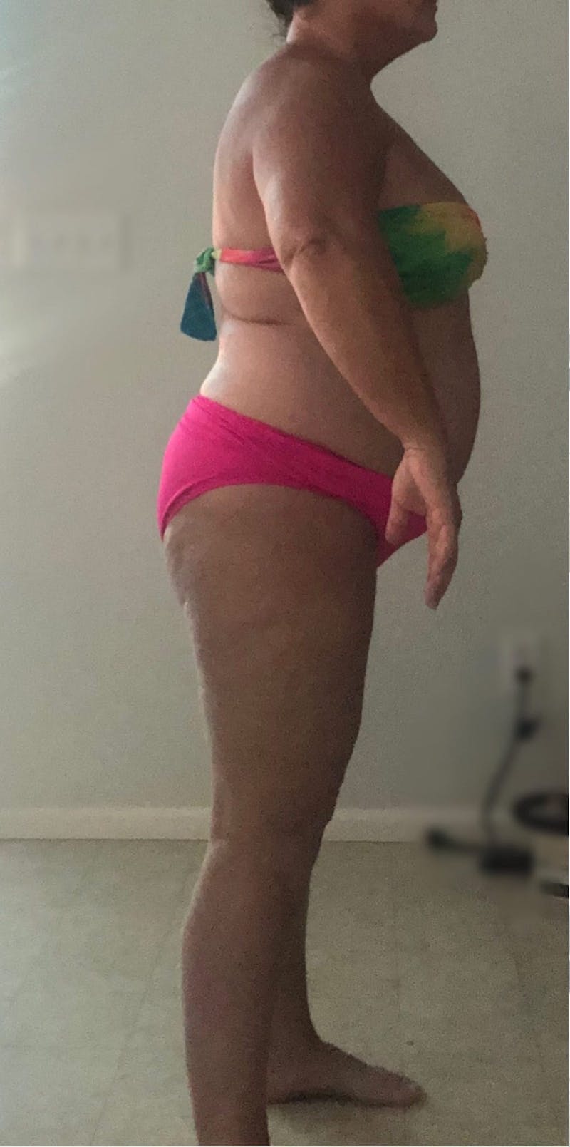 Patients 40-59 Years Old Before & After Gallery - Patient 55962172 - Image 1