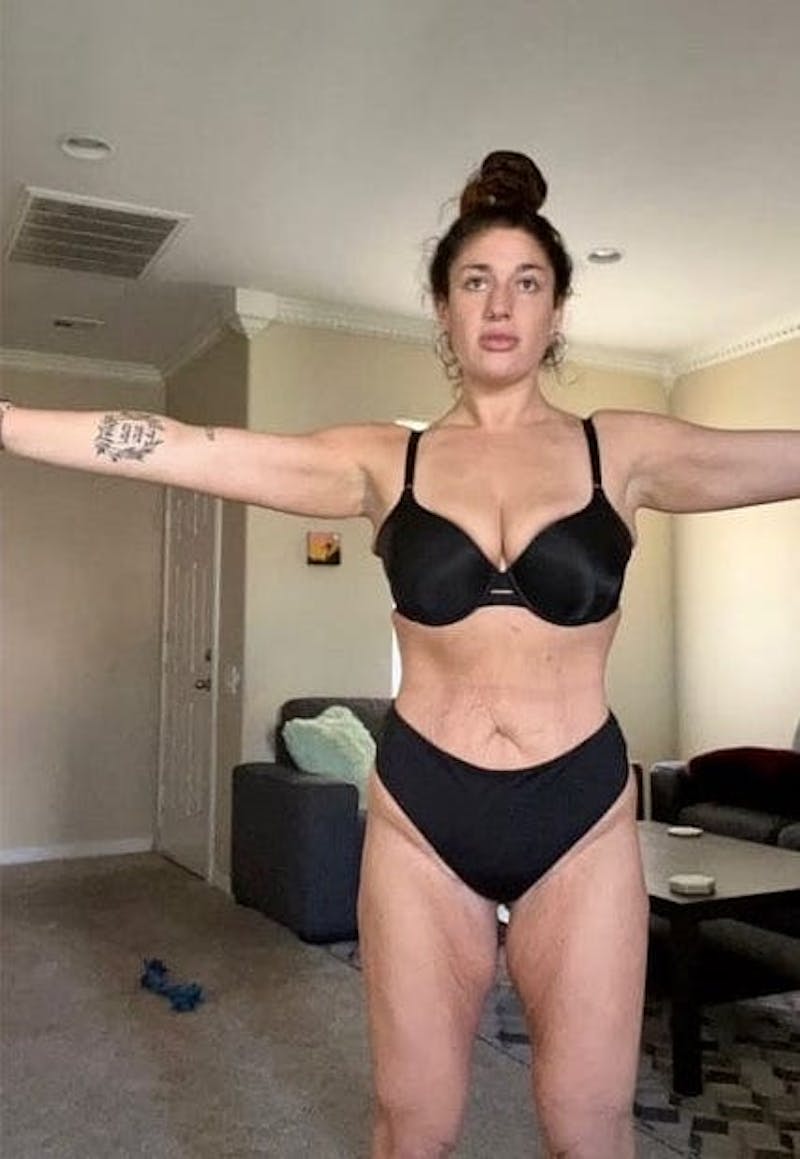 Patients 20-39 Years Old Before & After Gallery - Patient 56055573 - Image 2