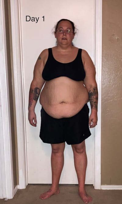 Patients 40-59 Years Old Before & After Gallery - Patient 56055575 - Image 1