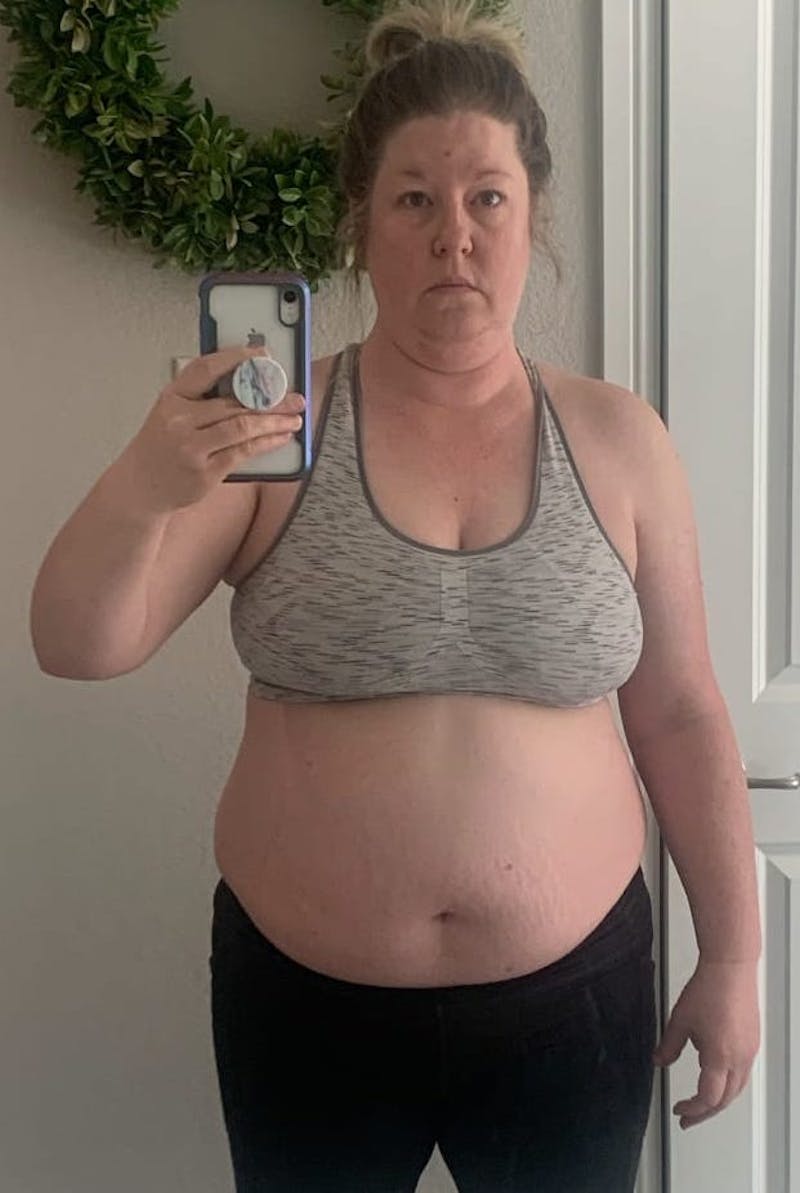 Patients 40-59 Years Old Before & After Gallery - Patient 63799142 - Image 1