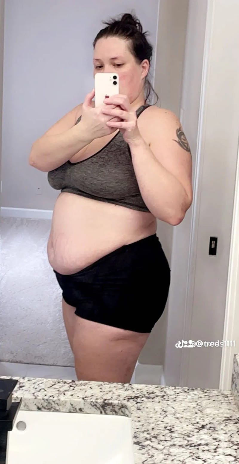 Patients 20-39 Years Old Before & After Gallery - Patient 63885405 - Image 1