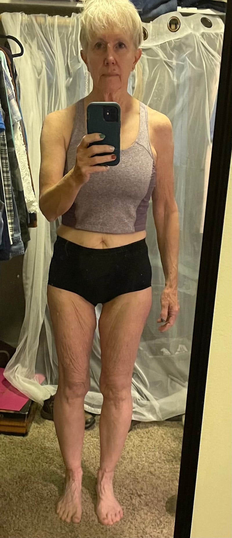 Patients 60-88 Years Old Before & After Gallery - Patient 64012053 - Image 2