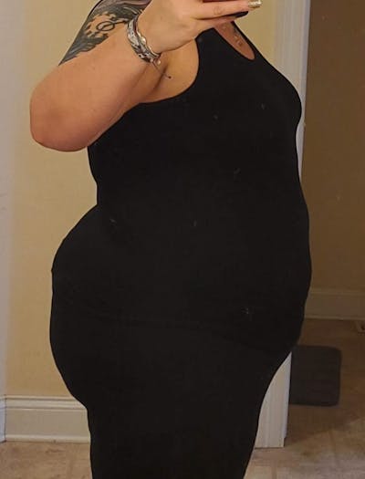 Patients 40-59 Years Old Before & After Gallery - Patient 64076466 - Image 1