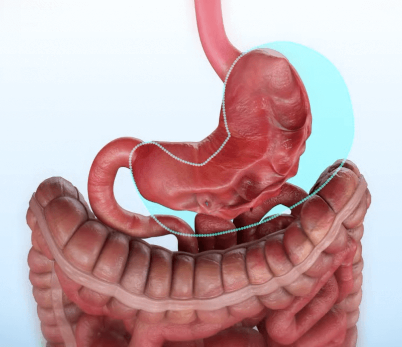 Endoscopic Sleeve Tijuana Endoscopic Sleeve Mexico