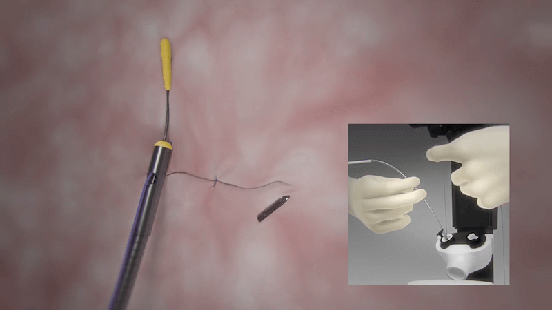 Endoscopic Sleeve Tijuana | Endoscopic Sleeve Mexico
