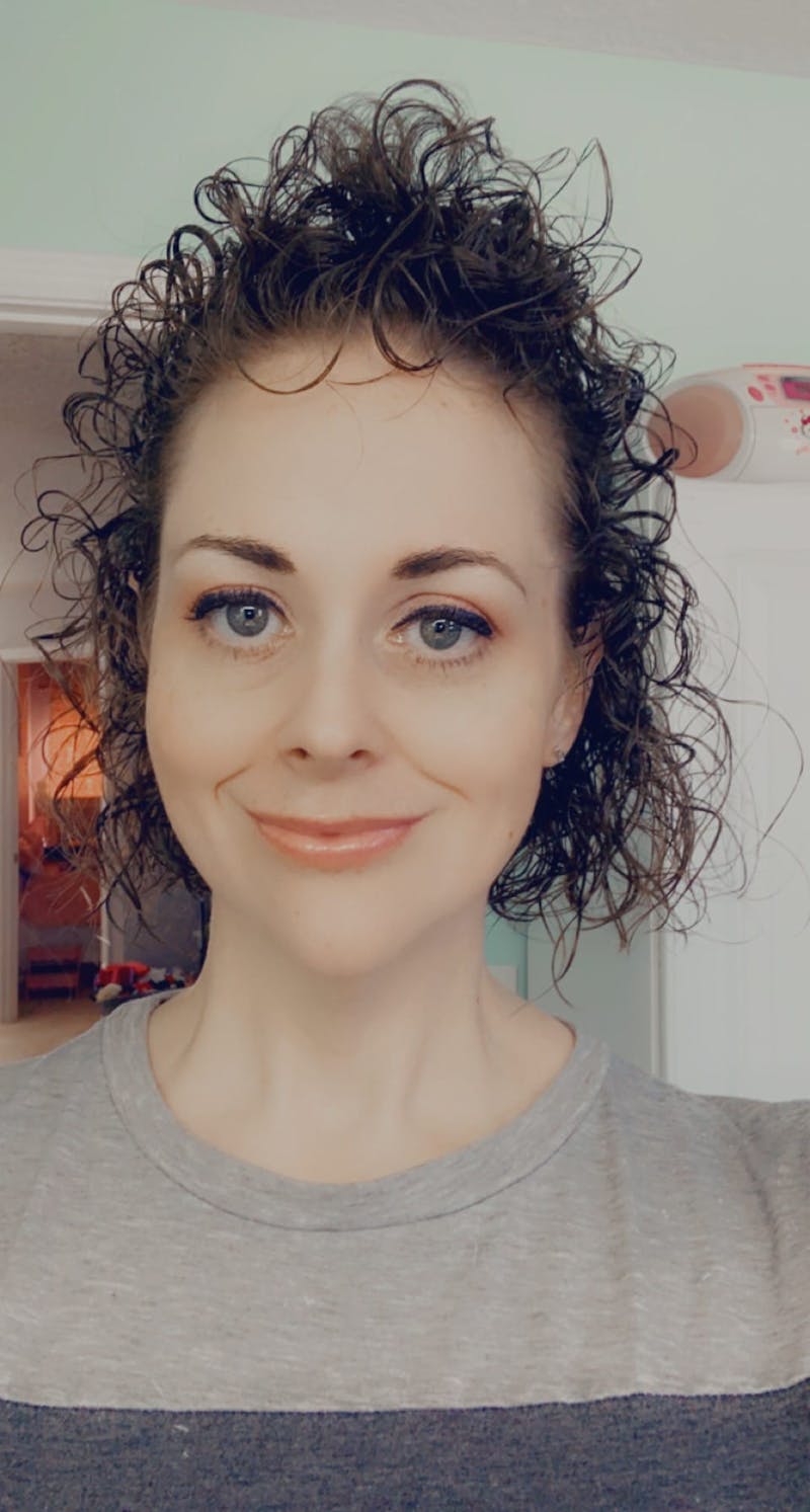 Patients 20-39 Years Old Before & After Gallery - Patient 73511729 - Image 2