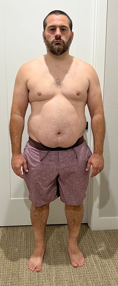 Patients 40-59 Years Old Before & After Gallery - Patient 94222163 - Image 1