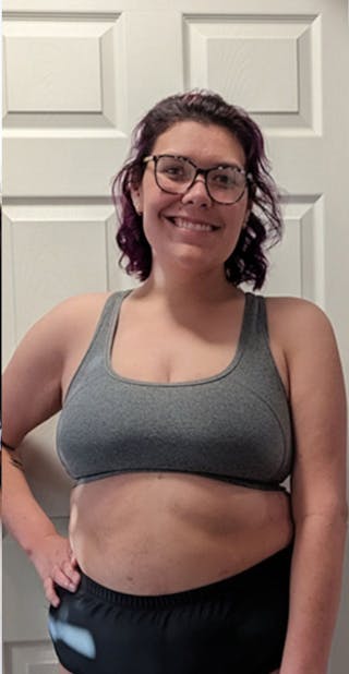 Patients 20-39 Years Old Before & After Gallery - Patient 114201839 - Image 2