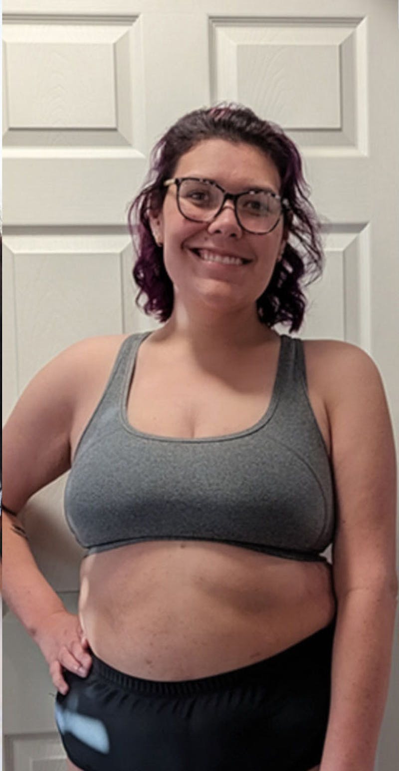 Patients 20-39 Years Old Before & After Gallery - Patient 114201839 - Image 2