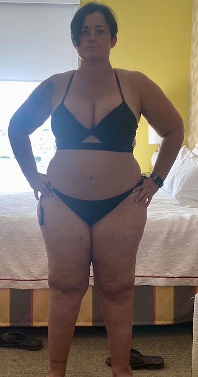 Patients 40-59 Years Old Before & After Gallery - Patient 139633845 - Image 1