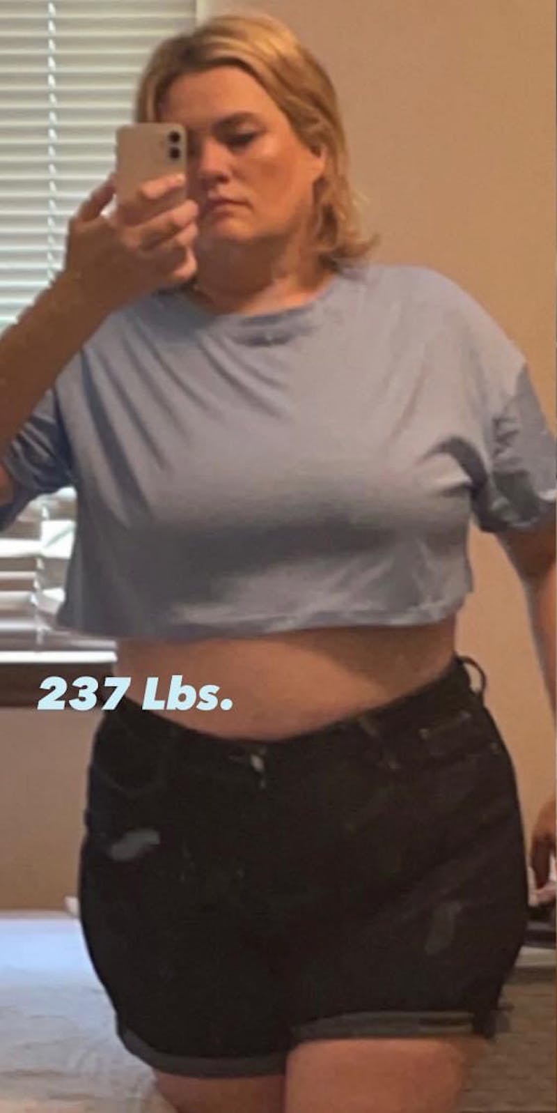 Patients 20-39 Years Old Before & After Gallery - Patient 142721540 - Image 1