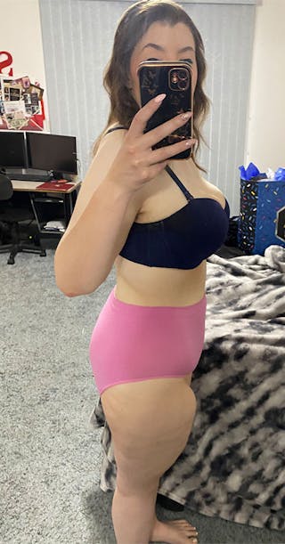 Patients 20-39 Years Old Before & After Gallery - Patient 142728119 - Image 2