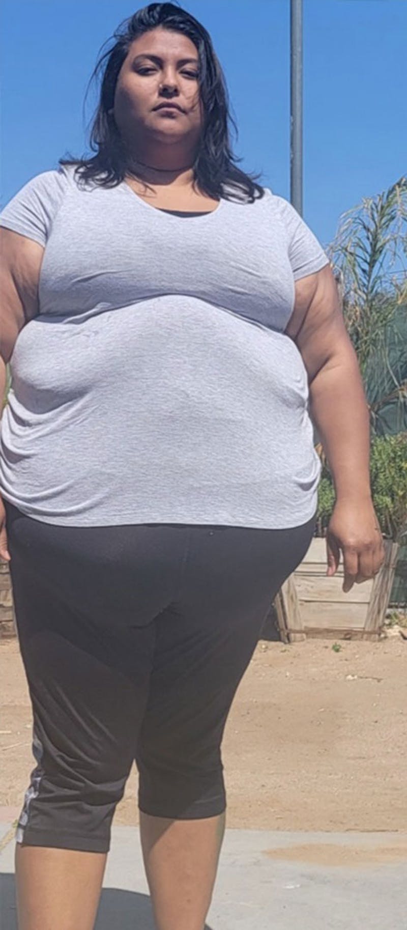 Patients 20-39 Years Old Before & After Gallery - Patient 182122195 - Image 1