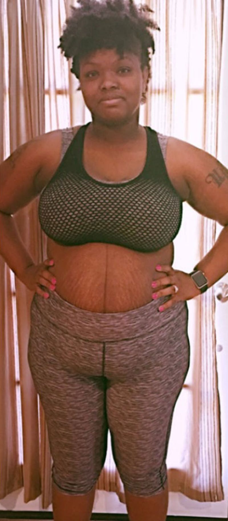 Patients 20-39 Years Old Before & After Gallery - Patient 182122196 - Image 1