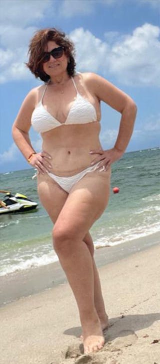 Patients 40-59 Years Old Before & After Gallery - Patient 189887538 - Image 2