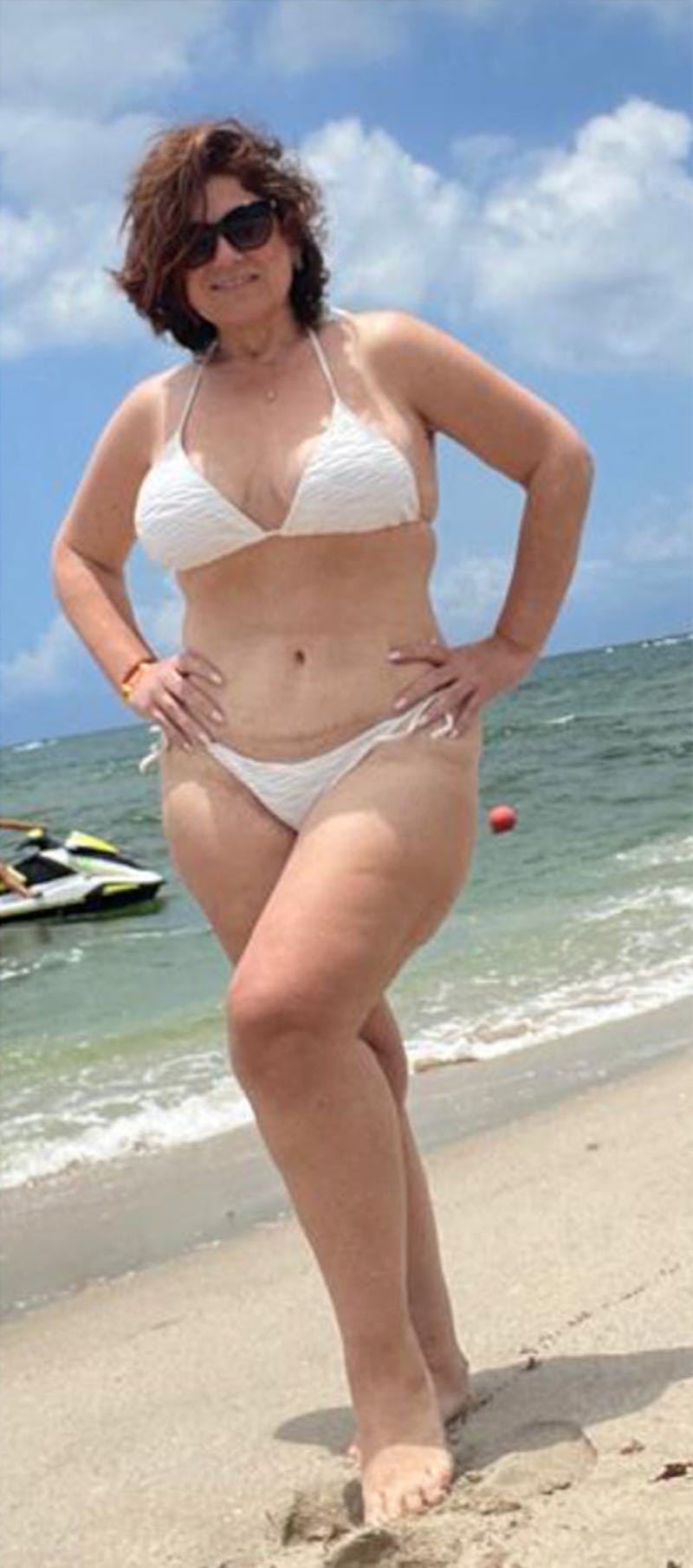 Patients 40-59 Years Old Before & After Gallery - Patient 189887538 - Image 2