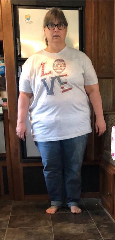 Patients 40-59 Years Old Before & After Gallery - Patient 189887627 - Image 1