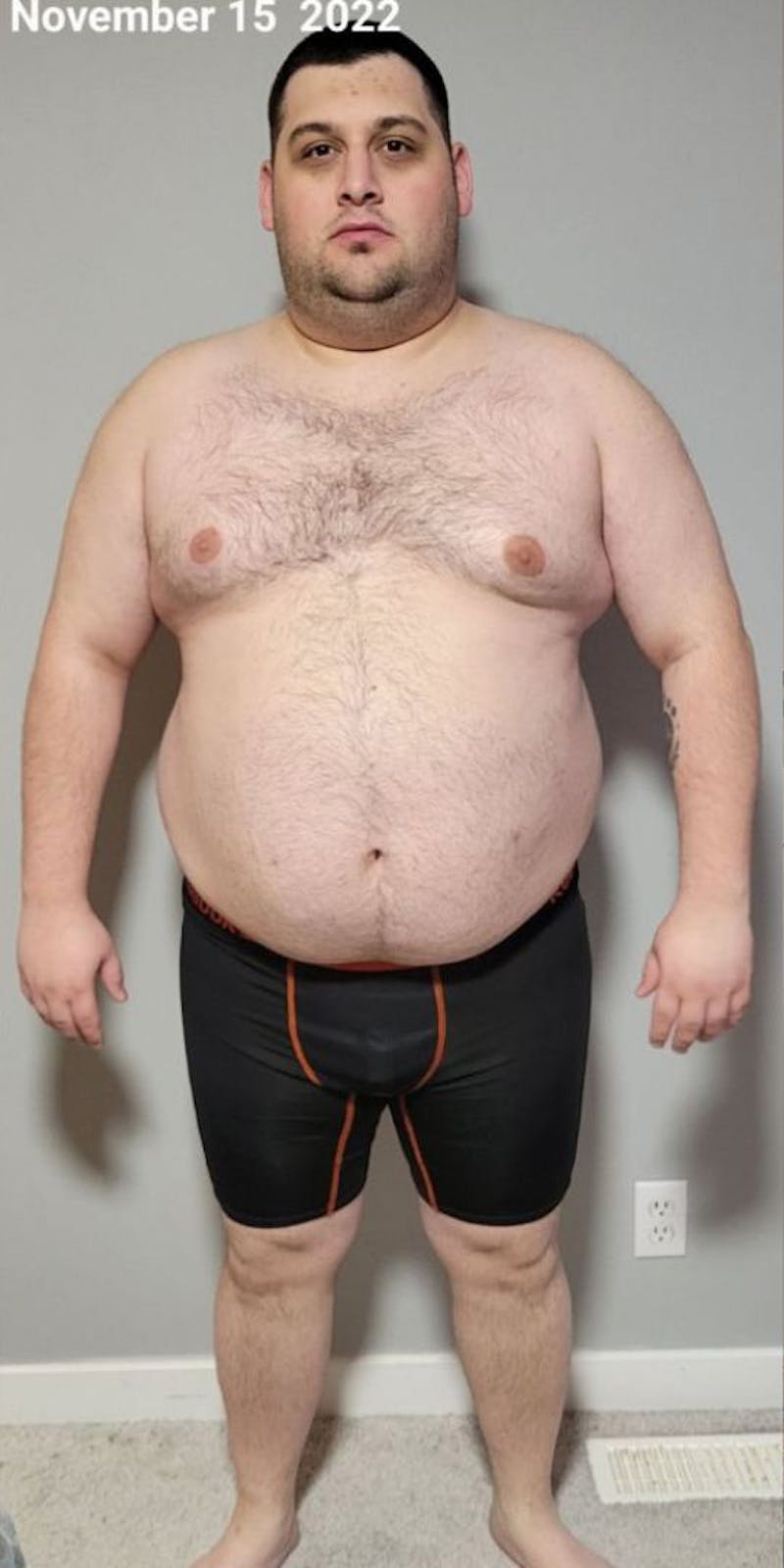 Patients 20-39 Years Old Before & After Gallery - Patient 242552 - Image 1